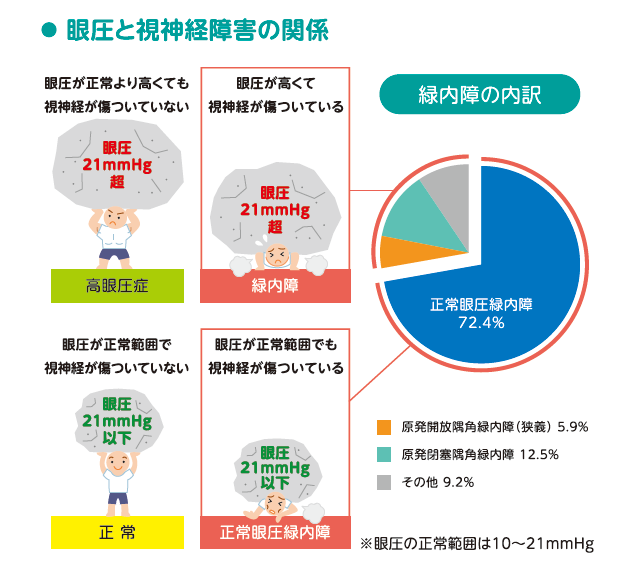 眼圧と視神経障害の関係