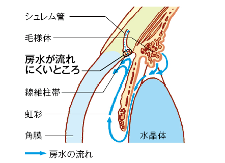 眼の拡大断面図（原発開放隅角緑内障）