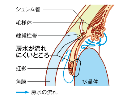 眼の拡大断面図（原発閉塞隅角緑内障）