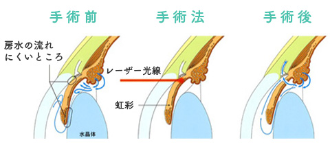 レーザー虹彩切開術