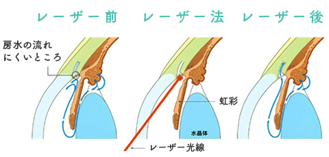 選択的レーザー線維柱帯形成術