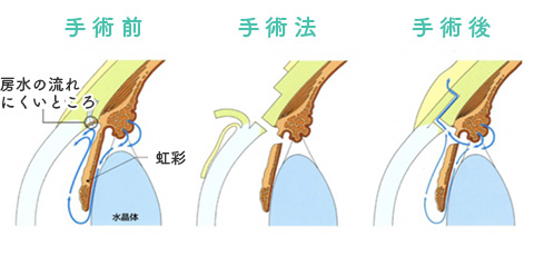 選択的レーザー線維柱帯形成術