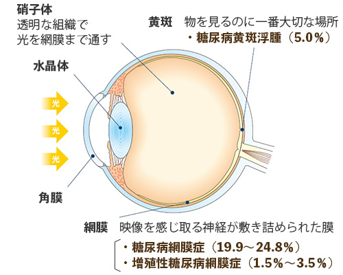 糖尿病網膜症