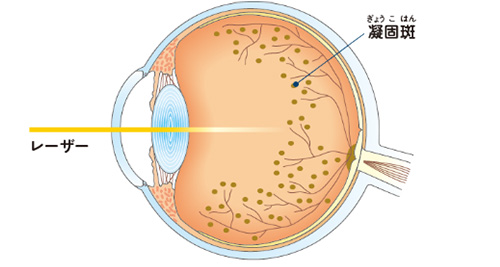 レーザー光凝固術