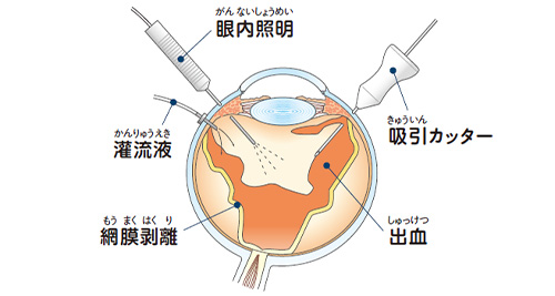 硝子体手術