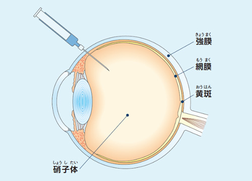 硝子体注射